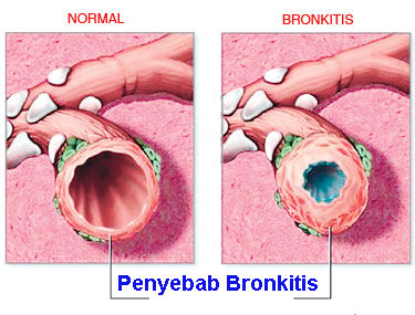 Penyebab Bronkitis